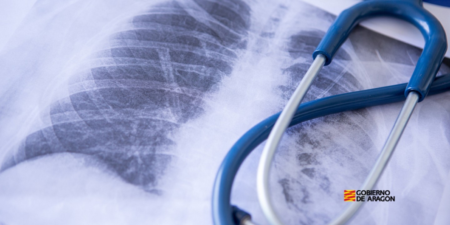 ¿Qué es y cómo afecta la hipertensión pulmonar?