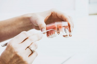 Dos de cada tres personas con implantes dentales tendrán algún tipo de enfermedad periimplantaria