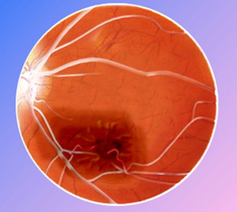 Casi 67 millones de personas de todo el mundo tienen glaucoma 